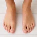 Flat feet